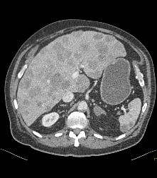 Metastatic Melanoma With Liver, Spleen, Left Perirenal and Paracardiac Nodes - CTisus CT Scan