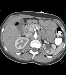 Left Ureteropelvic Junction (UPJ) Obstruction - CTisus CT Scan