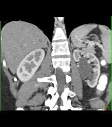 Left Ureteropelvic Junction (UPJ) Obstruction - CTisus CT Scan