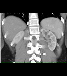 Left Ureteropelvic Junction (UPJ) Obstruction - CTisus CT Scan