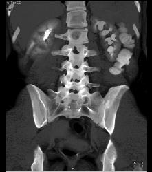 Left Ureteropelvic Junction (UPJ) Obstruction - CTisus CT Scan