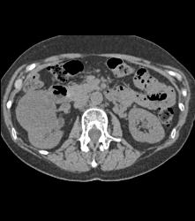 Vascular Renal Cell Caricnoma - CTisus CT Scan