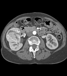 Vascular Renal Cell Caricnoma - CTisus CT Scan