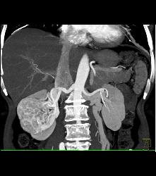 Vascular Renal Cell Caricnoma - CTisus CT Scan