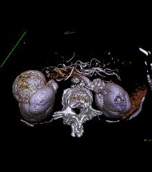 Vascular Renal Cell Caricnoma - CTisus CT Scan