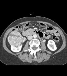 Vascular Renal Cell Caricnoma - CTisus CT Scan