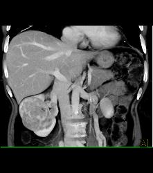 Vascular Renal Cell Caricnoma - CTisus CT Scan