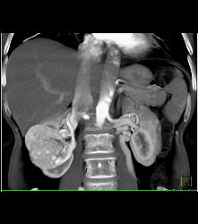 Vascular Renal Cell Caricnoma - CTisus CT Scan