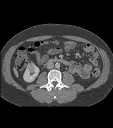 2cm Renal Cell Carcinoma - CTisus CT Scan