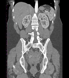 Scarring in Right Kidney - CTisus CT Scan