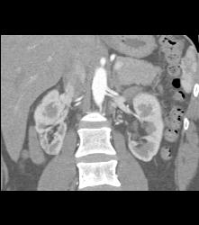 Scarring in Right Kidney - CTisus CT Scan