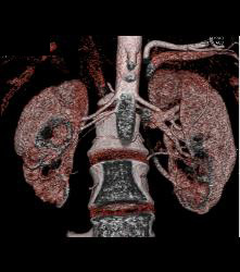 Scarring in Right Kidney - CTisus CT Scan