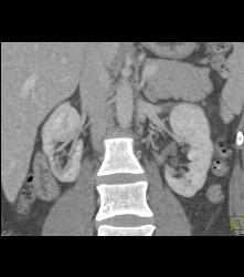 Scarring in Right Kidney - CTisus CT Scan