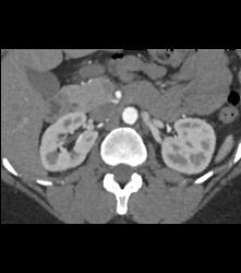 Scarring in Right Kidney - CTisus CT Scan