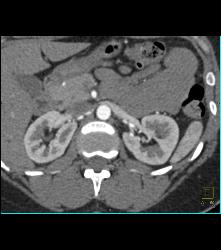 Scarring in Right Kidney - CTisus CT Scan