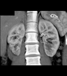 Scarring in Right Kidney - CTisus CT Scan