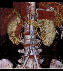 Scarring in Right Kidney - CTisus CT Scan