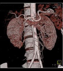 Scarring in Right Kidney - CTisus CT Scan