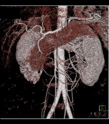 Scarring in Right Kidney - CTisus CT Scan