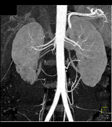 Scarring in Right Kidney - CTisus CT Scan