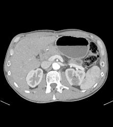 Prior Infarct Left Kidney With Scarring - CTisus CT Scan