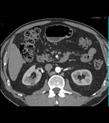 1 Cm Renal Cell Caricnoma - CTisus CT Scan