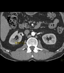 1 Cm Renal Cell Caricnoma - CTisus CT Scan