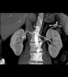 1 Cm Renal Cell Caricnoma - CTisus CT Scan