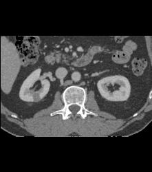 1 Cm Renal Cell Caricnoma - CTisus CT Scan