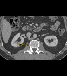 1 Cm Renal Cell Caricnoma - CTisus CT Scan