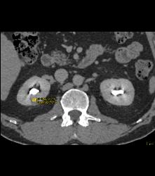 1 Cm Renal Cell Caricnoma - CTisus CT Scan