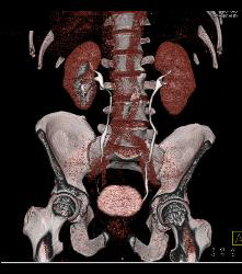 1 Cm Renal Cell Caricnoma - CTisus CT Scan