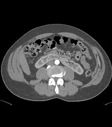 Horseshoe Kidney - CTisus CT Scan