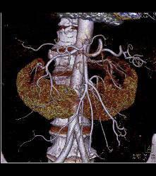 Horseshoe Kidney - CTisus CT Scan