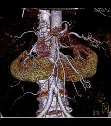 Horseshoe Kidney - CTisus CT Scan