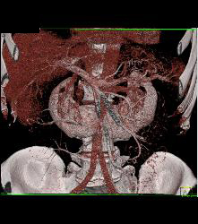 Horseshoe Kidney - CTisus CT Scan