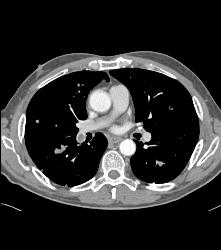 Pulmonary Embolism (PE) in Patient With Nephrectomy and Renal Cell Carcinoma - CTisus CT Scan