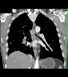 Pulmonary Embolism (PE) in Patient With Nephrectomy and Renal Cell Carcinoma - CTisus CT Scan