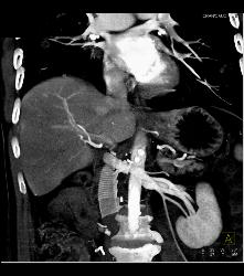 Pulmonary Embolism (PE) in Patient With Nephrectomy and Renal Cell Carcinoma - CTisus CT Scan