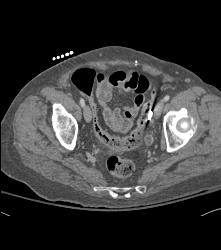 Left Ureteropelvic Junction (UPJ) - CTisus CT Scan