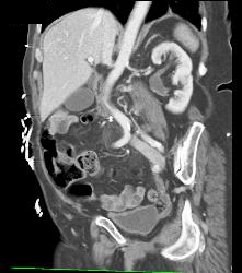 Left Ureteropelvic Junction (UPJ) - CTisus CT Scan