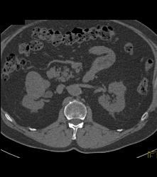 Cystic Renal Cell Carcinoma - CTisus CT Scan