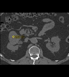 Cystic Renal Cell Carcinoma - CTisus CT Scan