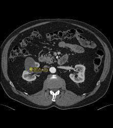 Cystic Renal Cell Carcinoma - CTisus CT Scan