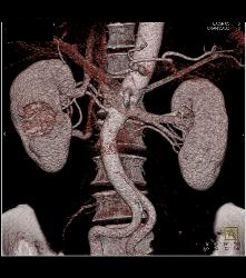 Cystic Renal Cell Carcinoma - CTisus CT Scan