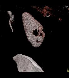 Cystic Renal Cell Carcinoma - CTisus CT Scan