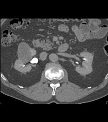 Cystic Renal Cell Carcinoma - CTisus CT Scan