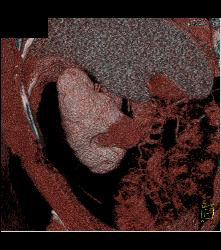 Cystic Renal Cell Carcinoma - CTisus CT Scan