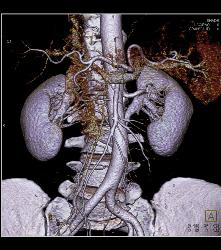 Cystic Renal Cell Carcinoma - CTisus CT Scan