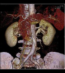 Cystic Renal Cell Carcinoma - CTisus CT Scan